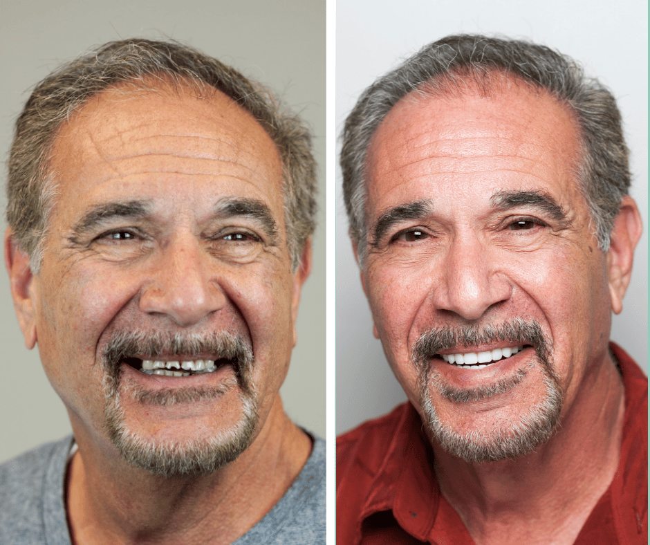 Before and after All-on-X dental implants